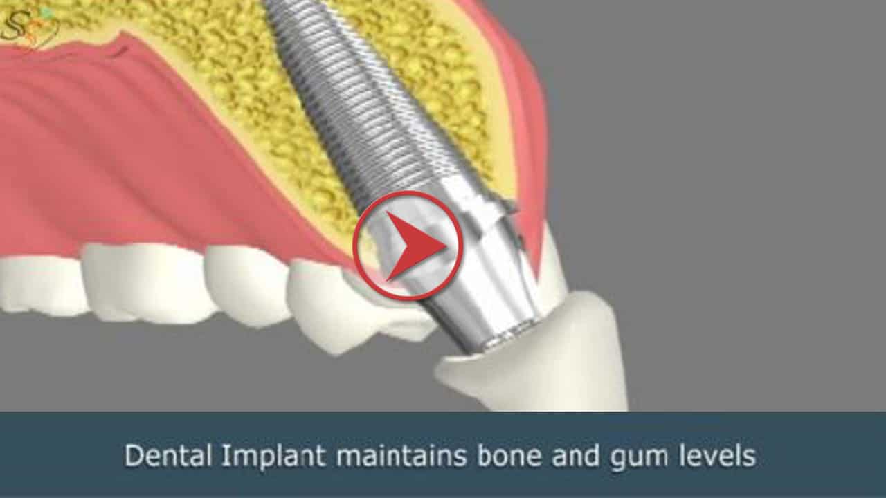 Dental Implants Services in Key West Florida