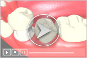 Dental Crowns Services in Key West Florida