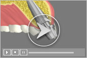 Dental Implants Services in Key West Florida