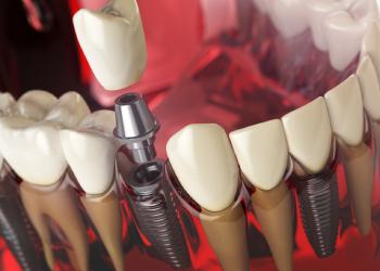 Step-by-Step Process for Dental Implants in Key West