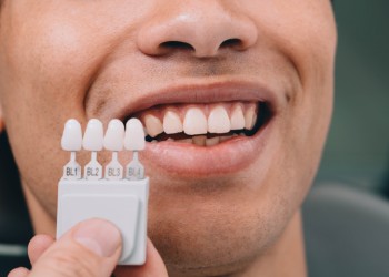 The Step-by-Step Process of Dental Veneers in Key West