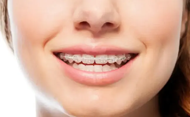 Clear Braces in Key West Florida