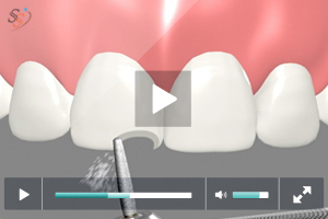 tooth colored fillings - Class IV