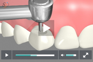 tooth colored fillings - Class V