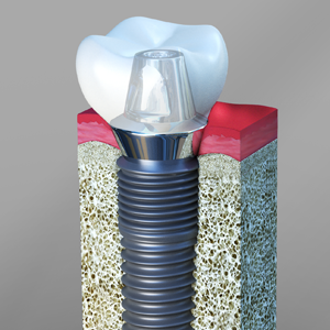 Dental Implants Key West