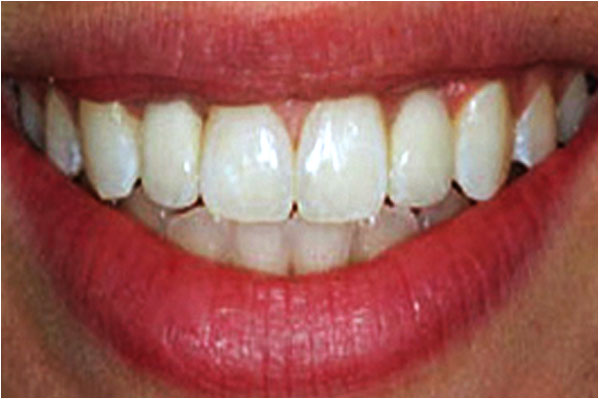 Dental Implants After 