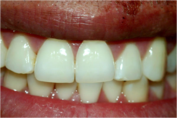 Dental Crowns After 